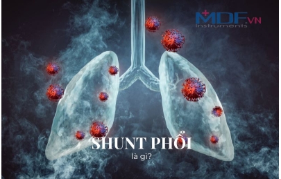 Shunt phổi là gì? Tìm hiểu về tình trạng suy hô hấp cấp giảm oxy