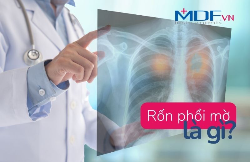 Rốn Phổi Mờ Là Gì? Biểu Hiệu Nguy Hiểm Bạn Cần Phải Biết
